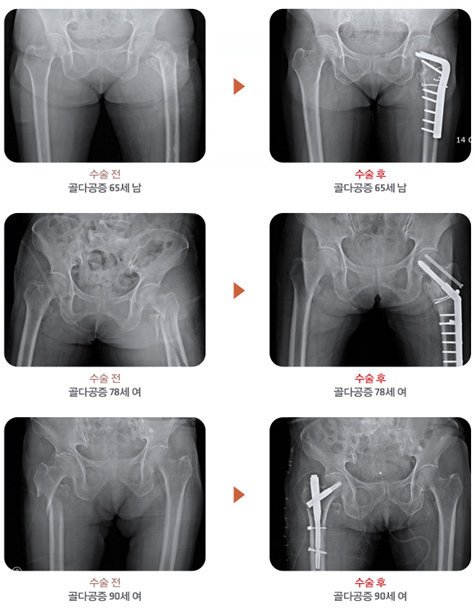°í°üÀýºÎ(¾ûµ¢ÀÌ) °ñÀý Ä¡·á À̹ÌÁö